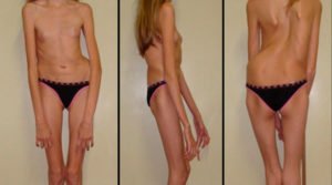 Genética Médica. Síndrome de Marfan