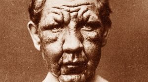 Hanseníase no Brasil